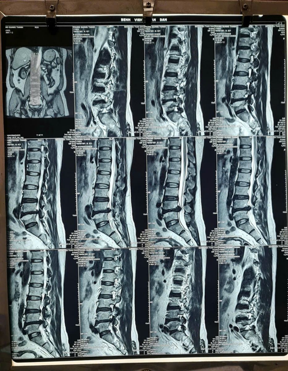 Thoát vị đĩa đệm chèn dây thần kinh